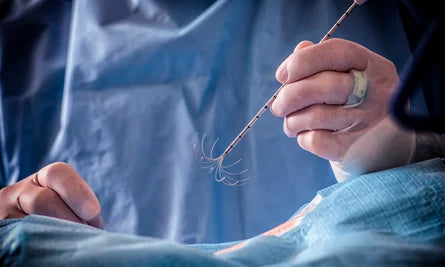 Can A Husband Stitch Be Reversed