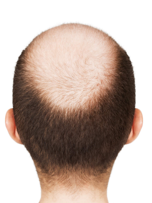 Why Is My Boyfriend Balding