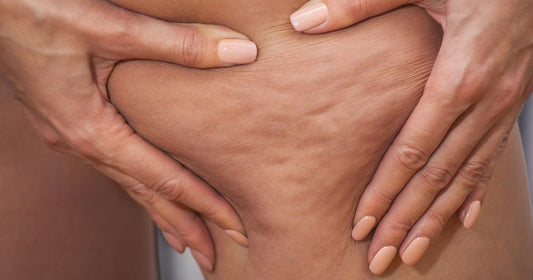 Do Guys Dislike Cellulite