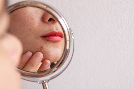 Do Girls Care About Acne
